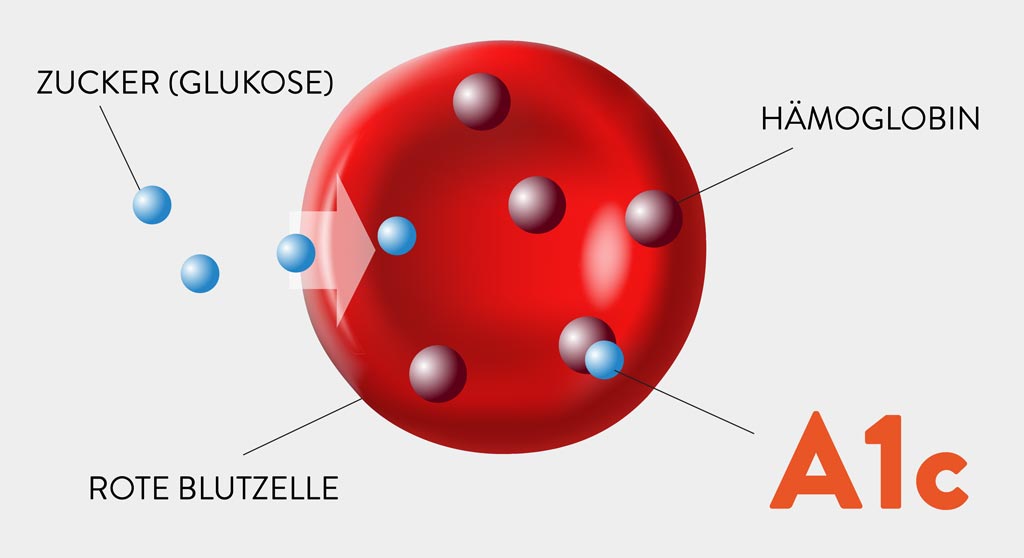 Glukose, die sich an das Hämoglobin in roten Blutzellen bindet, zeigt sich als HbA1c. (owned by Abbott)